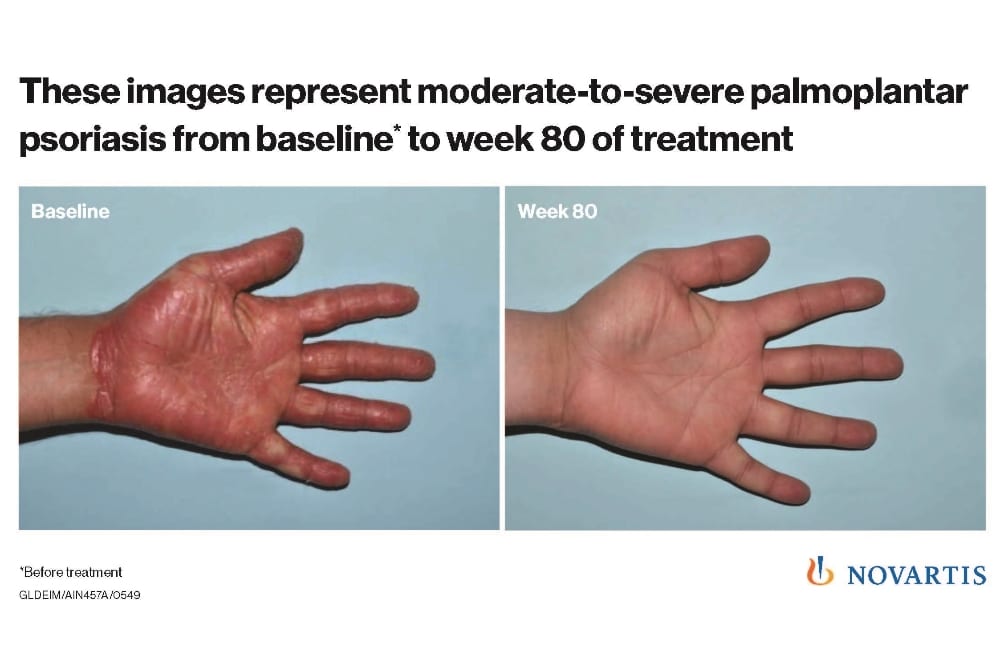 Un médicament de Novartis performant